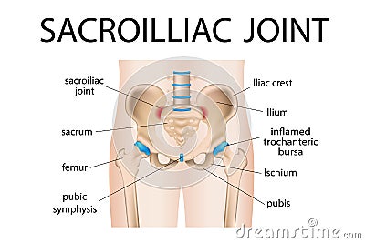 Inflammation of the sacroiliac joint of the lower back. Cartoon Illustration